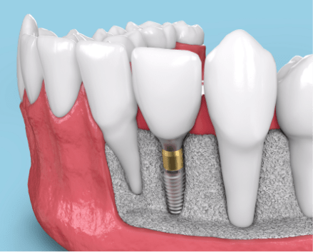 Dental implants today